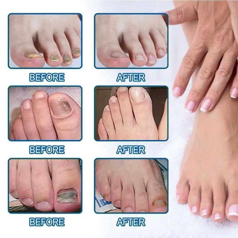 Nighttime Fungal Nail Treatment Patches – Anti-Fungal Nail Repair Kit